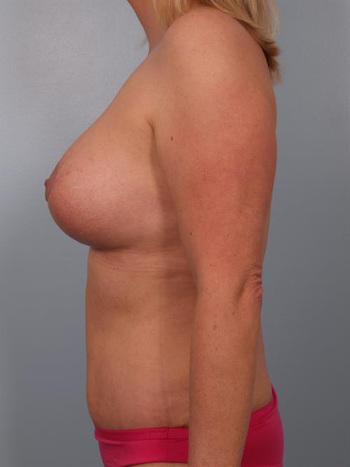 Tummy Tuck After Photo | Phoenix and Scottsdale, AZ | Scottsdale Center for Plastic Surgery