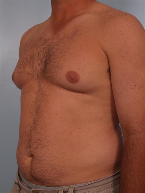 Male Breast/Areola Reduction Before Photo | Phoenix and Scottsdale, AZ | Scottsdale Center for Plastic Surgery