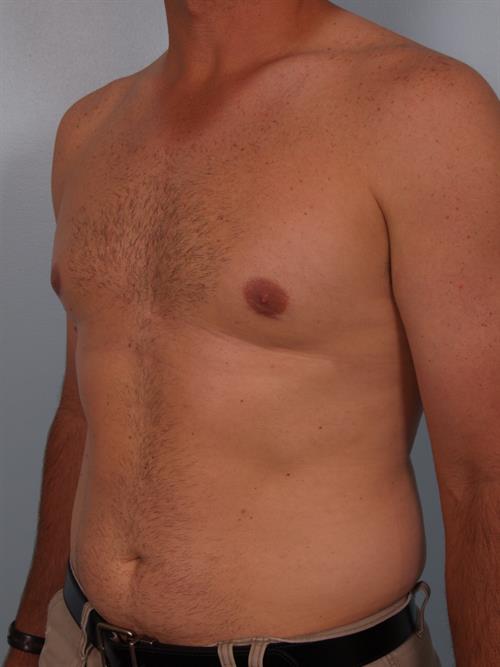 Male Breast/Areola Reduction After Photo | Phoenix and Scottsdale, AZ | Scottsdale Center for Plastic Surgery