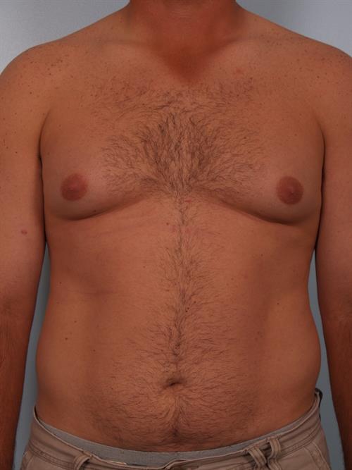 Male Breast/Areola Reduction Before Photo | Phoenix and Scottsdale, AZ | Scottsdale Center for Plastic Surgery