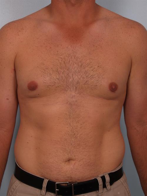 Male Breast/Areola Reduction After Photo | Phoenix and Scottsdale, AZ | Scottsdale Center for Plastic Surgery