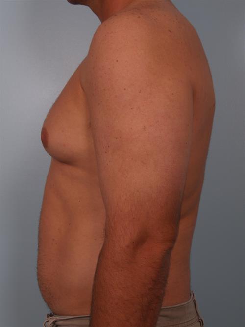 Male Breast/Areola Reduction Before Photo | Phoenix and Scottsdale, AZ | Scottsdale Center for Plastic Surgery