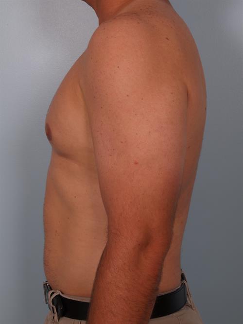 Male Breast/Areola Reduction After Photo | Phoenix and Scottsdale, AZ | Scottsdale Center for Plastic Surgery