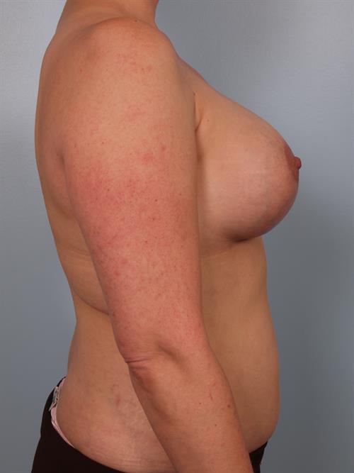 Revision Breast Surgery After Photo | Phoenix and Scottsdale, AZ | Scottsdale Center for Plastic Surgery