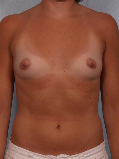 Breast Augmentation Before Photo | Phoenix and Scottsdale, AZ | Scottsdale Center for Plastic Surgery