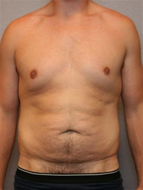 Male Liposuction Before Photo | Phoenix and Scottsdale, AZ | Scottsdale Center for Plastic Surgery