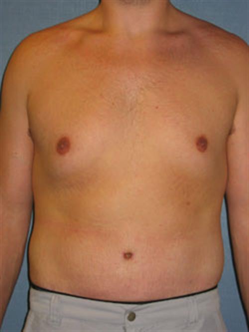 Male Liposuction After Photo | Phoenix and Scottsdale, AZ | Scottsdale Center for Plastic Surgery