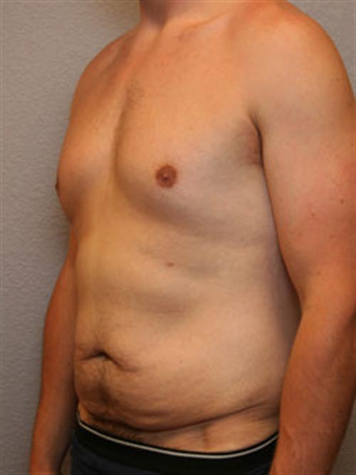 Tummy Tuck Before Photo | Phoenix and Scottsdale, AZ | Scottsdale Center for Plastic Surgery