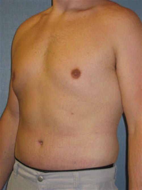 Tummy Tuck After Photo | Phoenix and Scottsdale, AZ | Scottsdale Center for Plastic Surgery