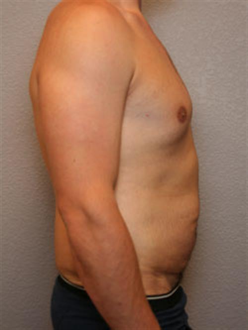 Tummy Tuck Before Photo | Phoenix and Scottsdale, AZ | Scottsdale Center for Plastic Surgery