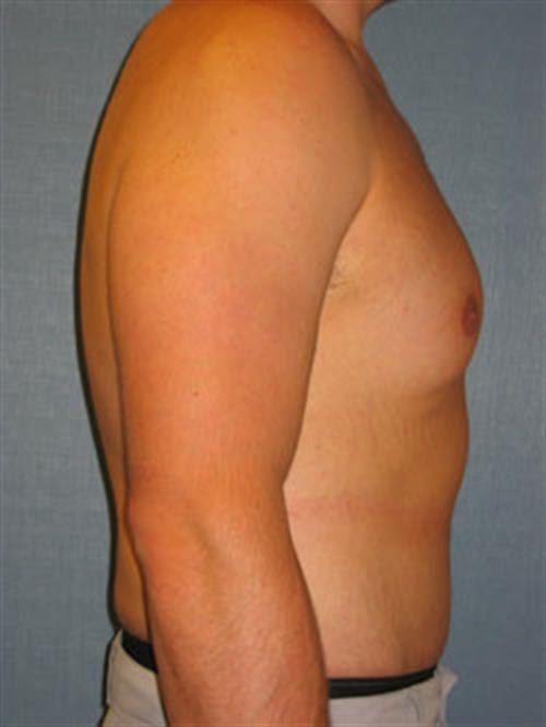 Male Tummy Tuck After Photo | ,  | 