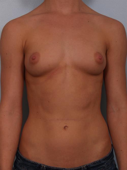 Breast Augmentation Before Photo | Phoenix and Scottsdale, AZ | Scottsdale Center for Plastic Surgery
