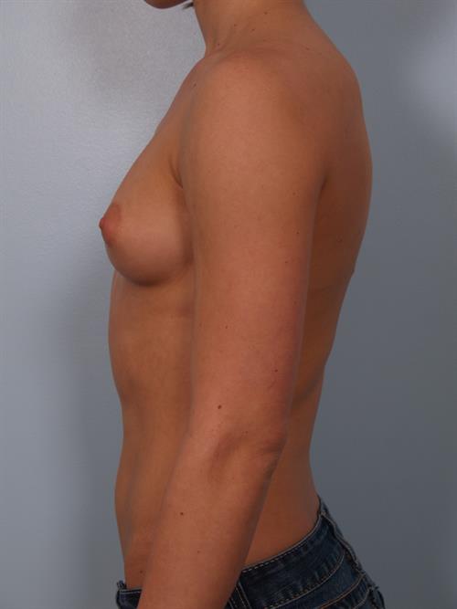 Breast Augmentation Before Photo | Phoenix and Scottsdale, AZ | Scottsdale Center for Plastic Surgery