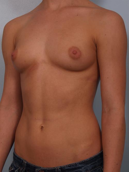 Breast Augmentation Before Photo | Phoenix and Scottsdale, AZ | Scottsdale Center for Plastic Surgery