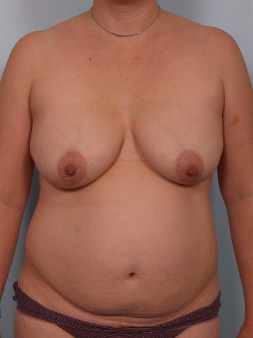 Tummy Tuck Before Photo | Phoenix and Scottsdale, AZ | Scottsdale Center for Plastic Surgery