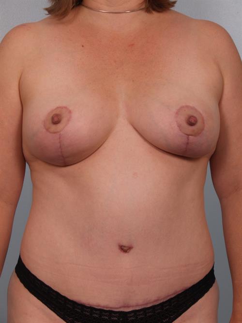 Tummy Tuck After Photo | Phoenix and Scottsdale, AZ | Scottsdale Center for Plastic Surgery