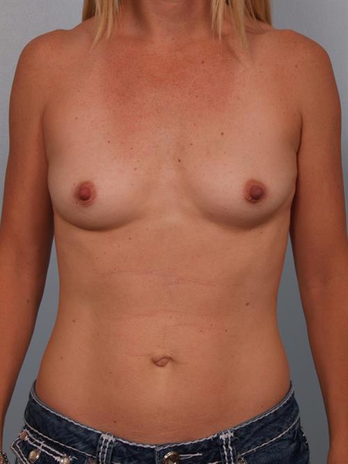 Breast Augmentation Before Photo | Phoenix and Scottsdale, AZ | Scottsdale Center for Plastic Surgery