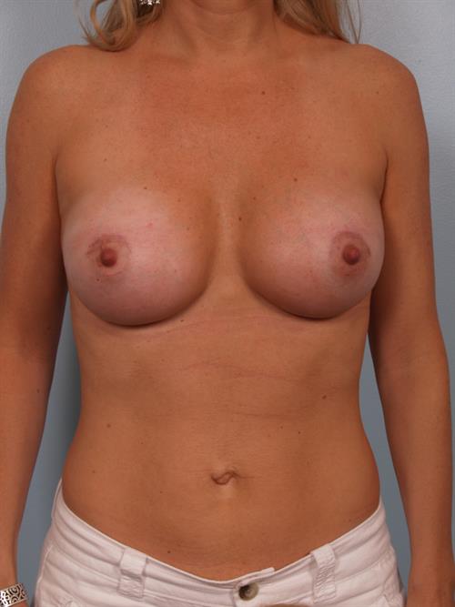 Breast Augmentation After Photo | Phoenix and Scottsdale, AZ | Scottsdale Center for Plastic Surgery