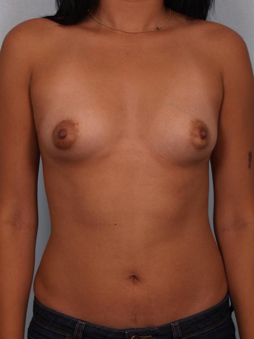 Breast Augmentation Before Photo | Phoenix and Scottsdale, AZ | Scottsdale Center for Plastic Surgery