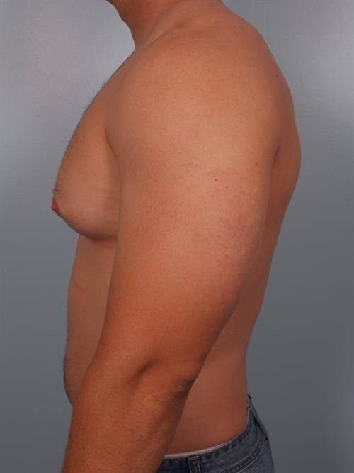 Male Breast/Areola Reduction Before Photo | Phoenix and Scottsdale, AZ | Scottsdale Center for Plastic Surgery