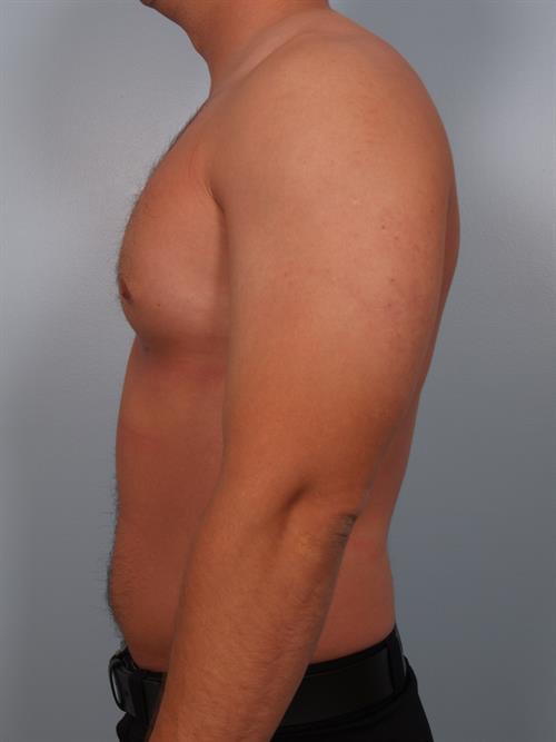 Male Breast/Areola Reduction After Photo | Phoenix and Scottsdale, AZ | Scottsdale Center for Plastic Surgery