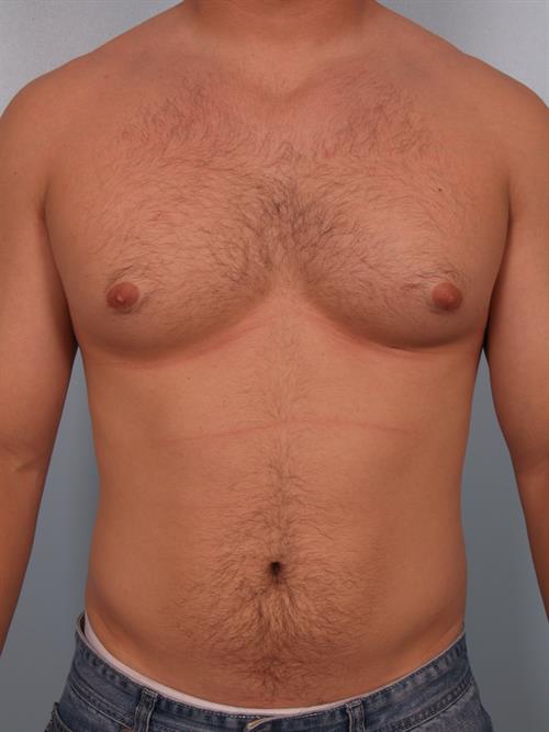 Male Breast/Areola Reduction Before Photo | Phoenix and Scottsdale, AZ | Scottsdale Center for Plastic Surgery