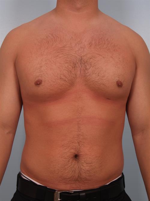 Male Breast/Areola Reduction After Photo | Phoenix and Scottsdale, AZ | Scottsdale Center for Plastic Surgery