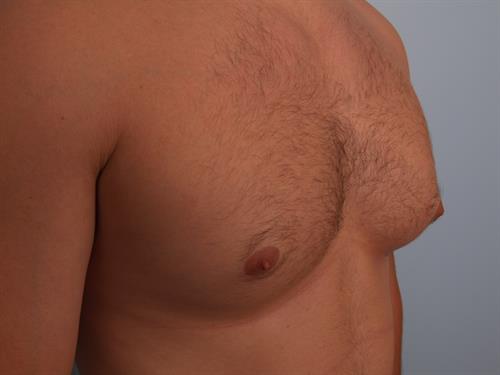 Male Breast/Areola Reduction Before Photo | Phoenix and Scottsdale, AZ | Scottsdale Center for Plastic Surgery