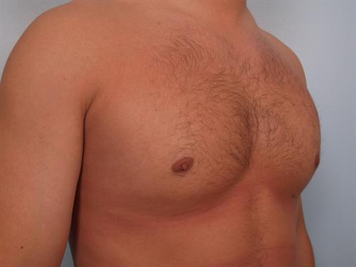 Male Breast/Areola Reduction After Photo | Phoenix and Scottsdale, AZ | Scottsdale Center for Plastic Surgery