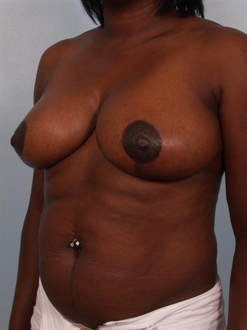 Breast Reduction After Photo | Phoenix and Scottsdale, AZ | Scottsdale Center for Plastic Surgery
