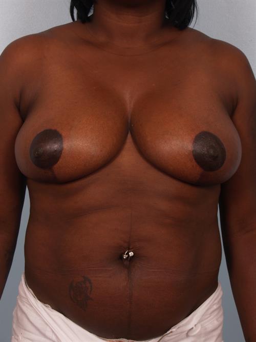 Breast Reduction After Photo | Phoenix and Scottsdale, AZ | Scottsdale Center for Plastic Surgery