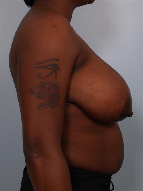 Breast Reduction Before Photo | Phoenix and Scottsdale, AZ | Scottsdale Center for Plastic Surgery