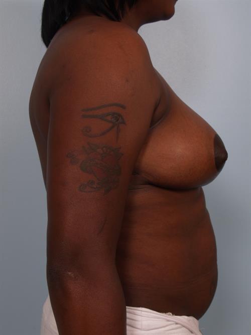 Breast Reduction After Photo | Phoenix and Scottsdale, AZ | Scottsdale Center for Plastic Surgery