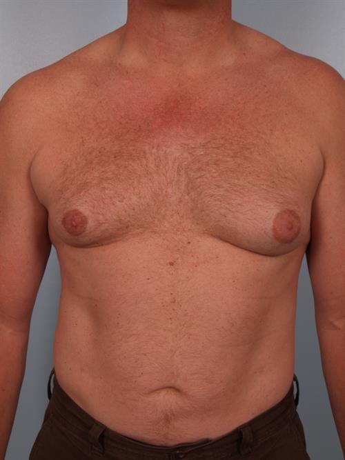 Male Breast/Areola Reduction Before Photo | Phoenix and Scottsdale, AZ | Scottsdale Center for Plastic Surgery