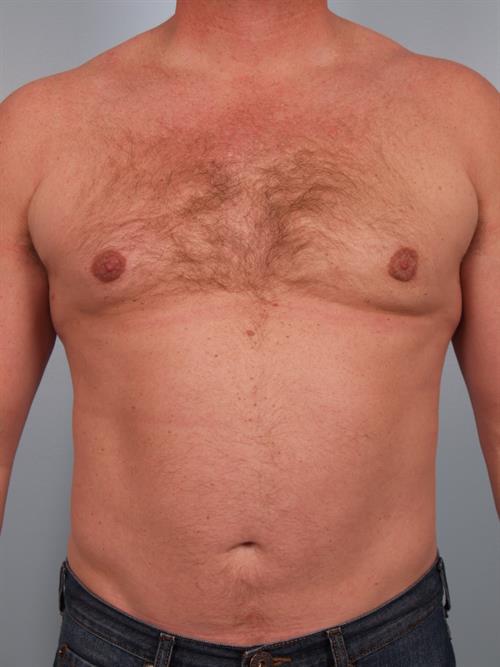 Male Breast/Areola Reduction After Photo | Phoenix and Scottsdale, AZ | Scottsdale Center for Plastic Surgery