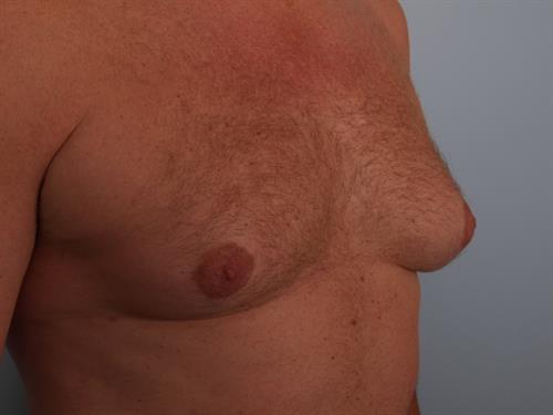 Male Breast/Areola Reduction Before Photo | Phoenix and Scottsdale, AZ | Scottsdale Center for Plastic Surgery