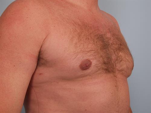 Male Breast/Areola Reduction After Photo | Phoenix and Scottsdale, AZ | Scottsdale Center for Plastic Surgery