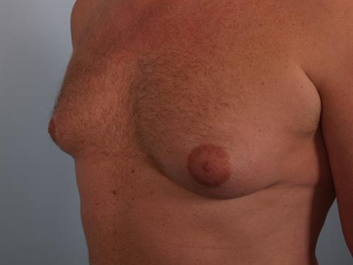 Male Breast/Areola Reduction Before Photo | Phoenix and Scottsdale, AZ | Scottsdale Center for Plastic Surgery