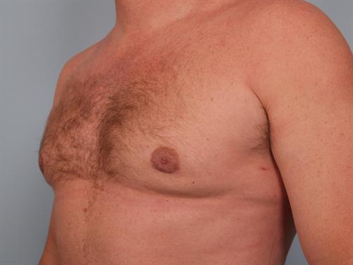 Male Breast/Areola Reduction After Photo | Phoenix and Scottsdale, AZ | Scottsdale Center for Plastic Surgery