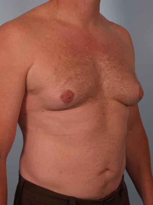 Male Breast/Areola Reduction Before Photo | Phoenix and Scottsdale, AZ | Scottsdale Center for Plastic Surgery