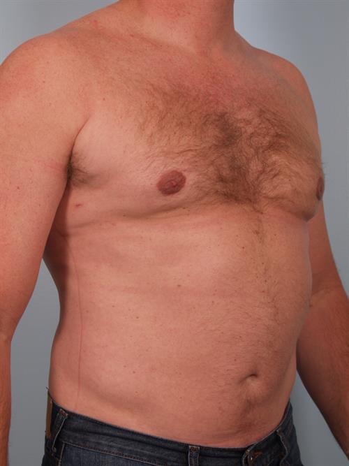 Male Breast/Areola Reduction After Photo | Phoenix and Scottsdale, AZ | Scottsdale Center for Plastic Surgery
