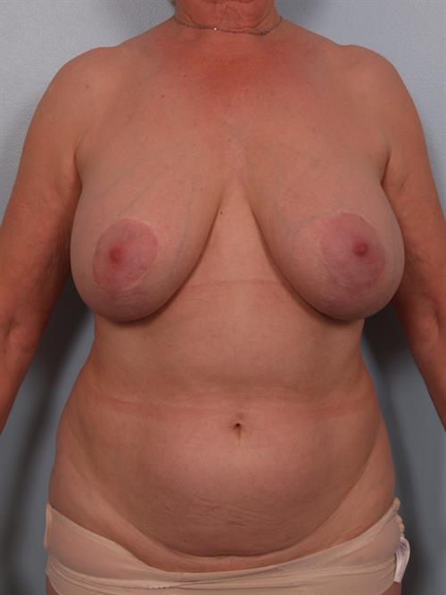 Tummy Tuck Before Photo | Phoenix and Scottsdale, AZ | Scottsdale Center for Plastic Surgery