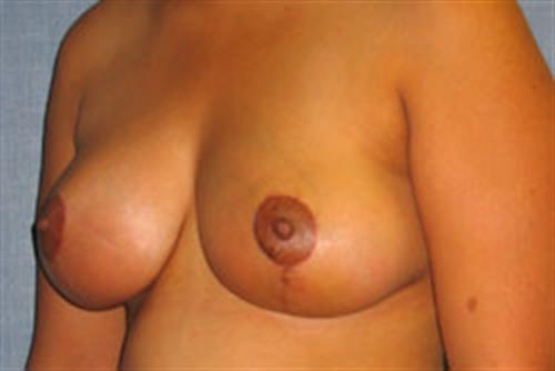 Breast Lift (Mastopexy) After Photo | Phoenix and Scottsdale, AZ | Scottsdale Center for Plastic Surgery