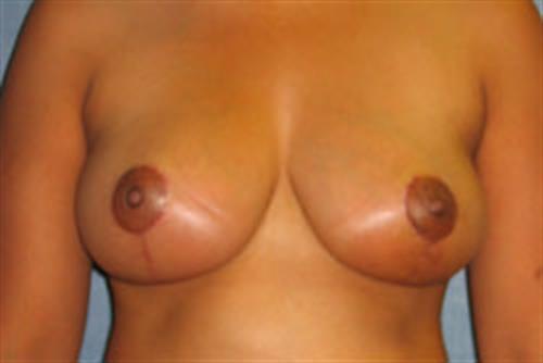 Breast Lift (Mastopexy) After Photo | Phoenix and Scottsdale, AZ | Scottsdale Center for Plastic Surgery