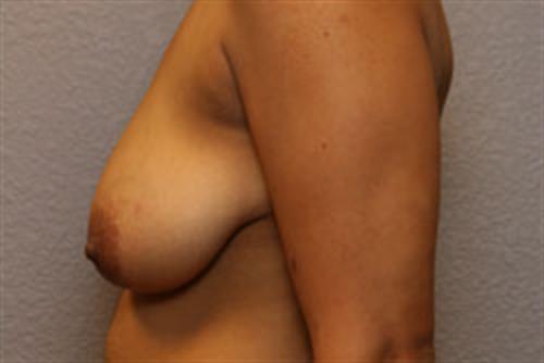 Breast Lift (Mastopexy) Before Photo | Phoenix and Scottsdale, AZ | Scottsdale Center for Plastic Surgery