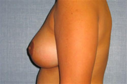Breast Lift (Mastopexy) After Photo | Phoenix and Scottsdale, AZ | Scottsdale Center for Plastic Surgery