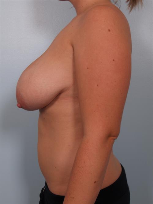 Breast Reduction Before Photo | Phoenix and Scottsdale, AZ | Scottsdale Center for Plastic Surgery