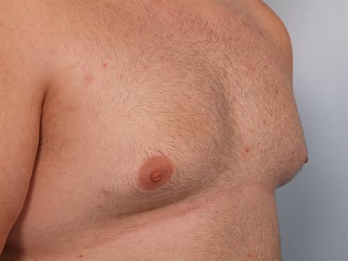 Male Breast/Areola Reduction Before Photo | Phoenix and Scottsdale, AZ | Scottsdale Center for Plastic Surgery