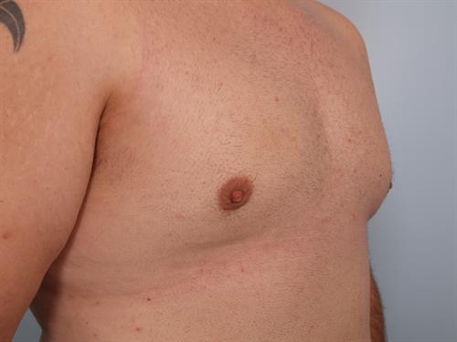 Male Breast/Areola Reduction After Photo | Phoenix and Scottsdale, AZ | Scottsdale Center for Plastic Surgery