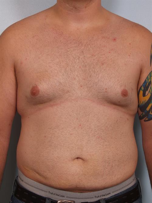Male Breast/Areola Reduction Before Photo | Phoenix and Scottsdale, AZ | Scottsdale Center for Plastic Surgery